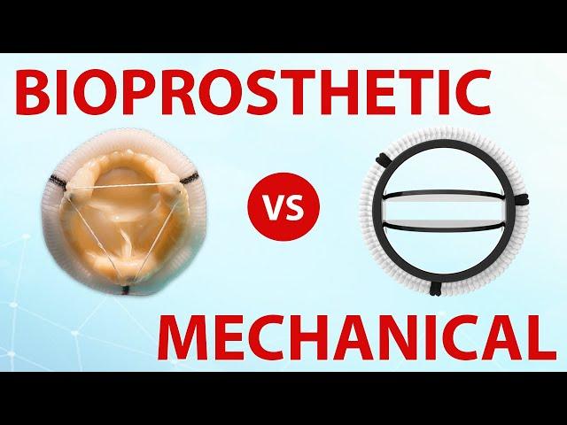 Mechanical or Bioprosthetic Heart Valves: Which Is Best For You?