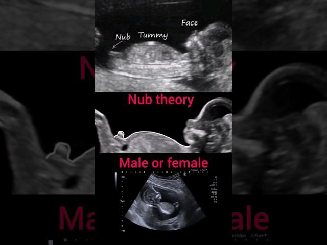 Nub theory||male or female||pregnancy #ultrasound#baby#shorts