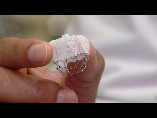 Local doctors using "Watchman" device to reduce stroke risk