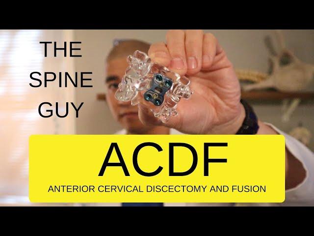 CERVICAL STENOSIS RADICULOPATHY - PART 5 - ACDF