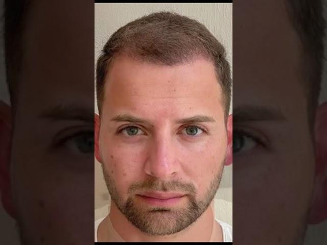 Hair Transplant Before and After | Elithair #shorts