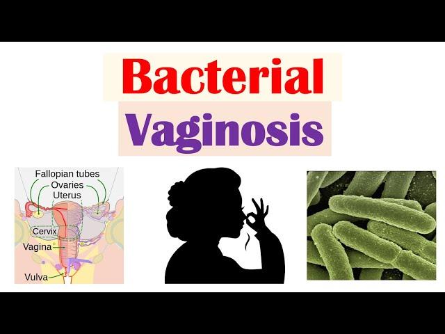 Bacterial Vaginosis (Vaginal Infection): Causes, Risk Factors, Symptoms, Diagnosis, Treatment