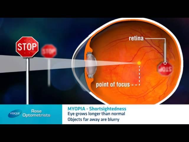 Short-sightedness - What is it? -  Rose Optometrists explain