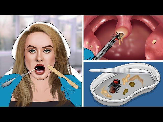 ASMR Remove The Fly & Tonsil Stone From Adele's Throat