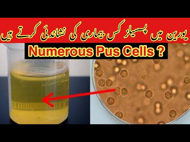 Numerous Pus Cells In Urine Urdu/hindi |What causes numerous pus cells in urine? Numerous Leukocytes