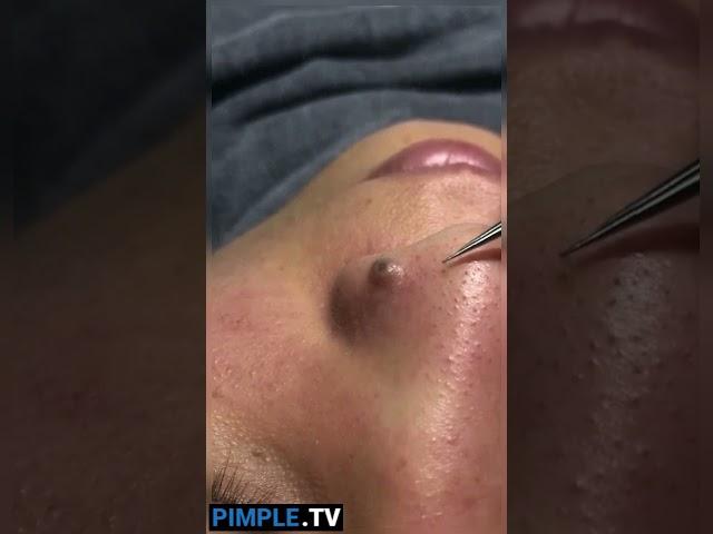 Extracting Large Blackheads Big Cystic Acne Blackheads&Whiteheads Removal Pimple Popping #143 #Short