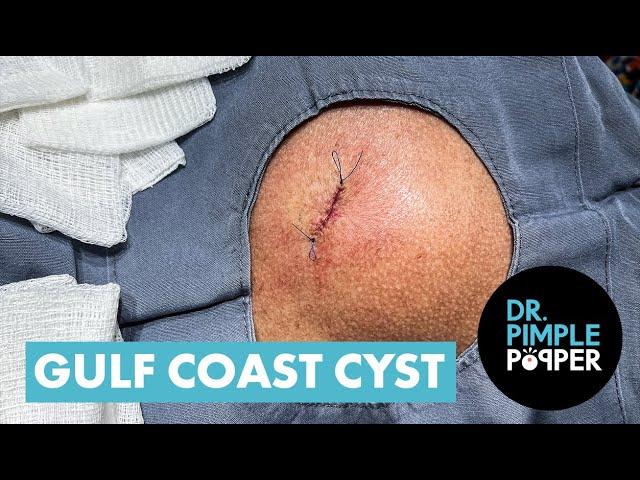 Dr Pimple Popper Opens The 'Gulf Coast' Cyst