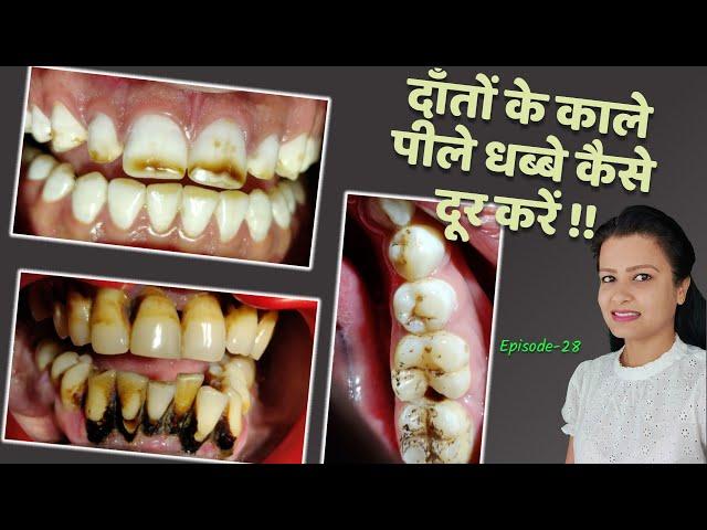 black spots on teeth how to remove home remedies | दांतों की सफाई Episode 28