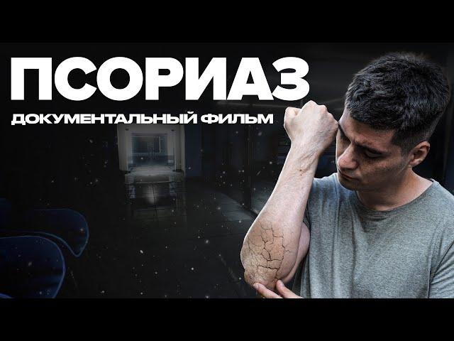 Псориаз | Документальный фильм