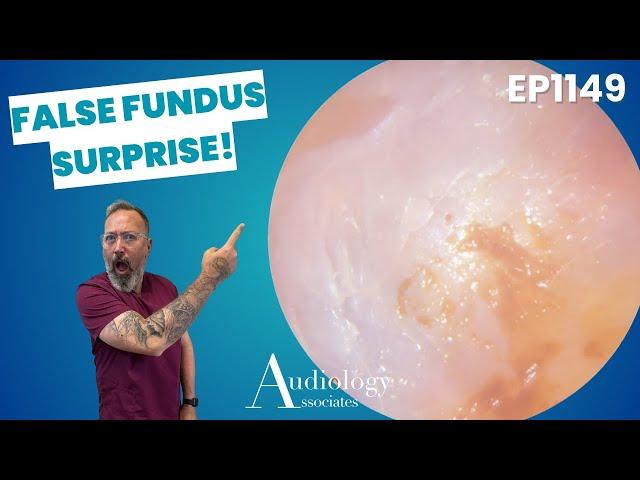Hard Wax Plugs & Satisfying Skin Peel | Microsuction Ear Wax Removal - EP1149
