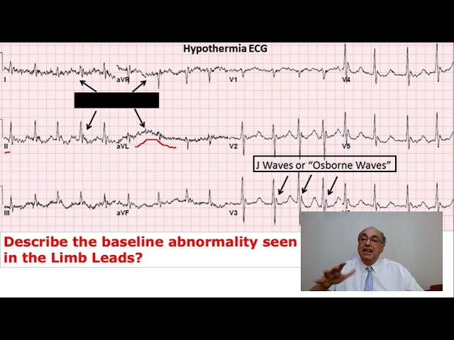 EKG Trainer (Case 39) Answer