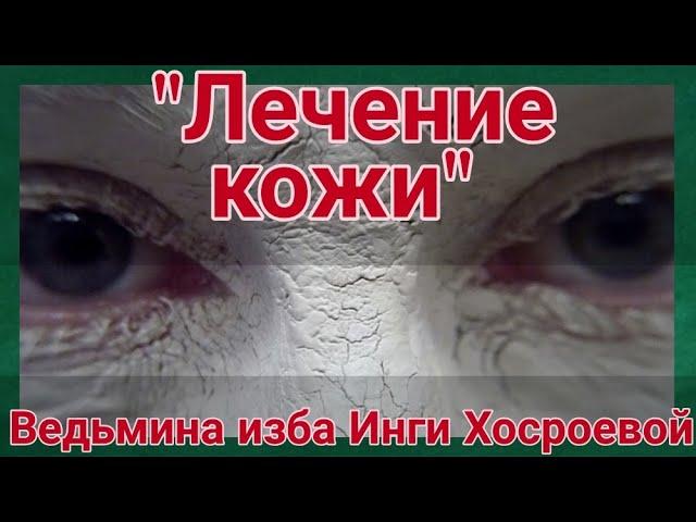 "ЛЕЧЕНИЕ КОЖИ" ДЛЯ ВСЕХ. ВЕДЬМИНА ИЗБА. ИНГА ХОСРОЕВА.