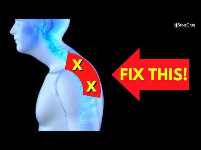 How to Fix a BACK HUMP for Good (No Equipment!)