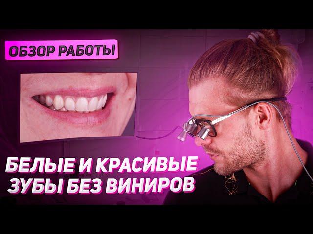 Как сделать зубы белыми и красивыми без виниров?