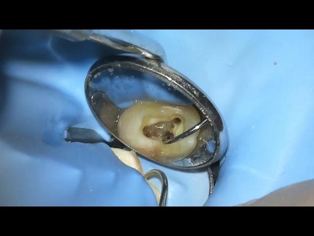 Live: Root Canal / Build-Up / Crown #3 - WaveOne Gold - Dr. Berlin