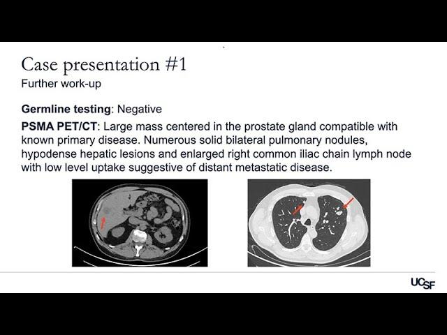 Advanced Prostate Cancer Cases