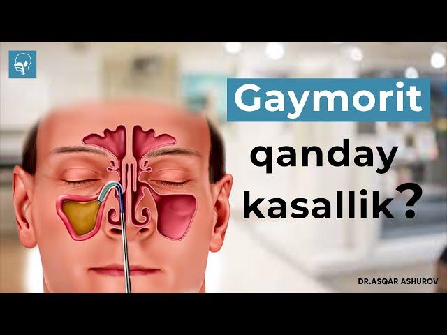 Gaymorit qanday kasallik? Gaymorit haqida biz bilmagan faktlar | Dr. Ashurov