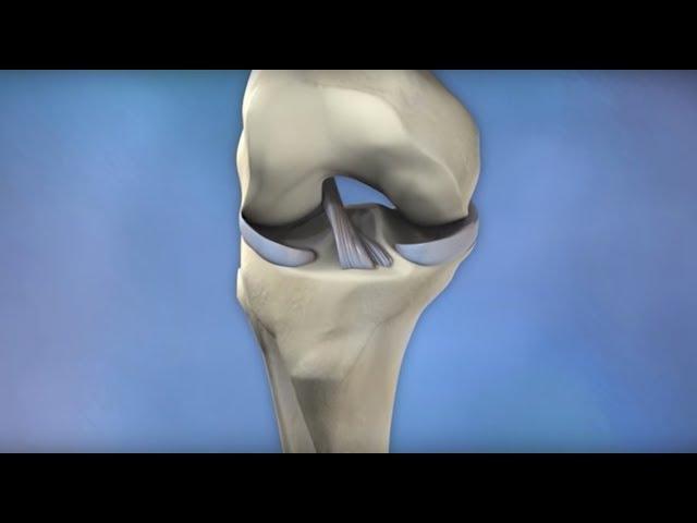 ACL Injury Prevention - Mayo Clinic