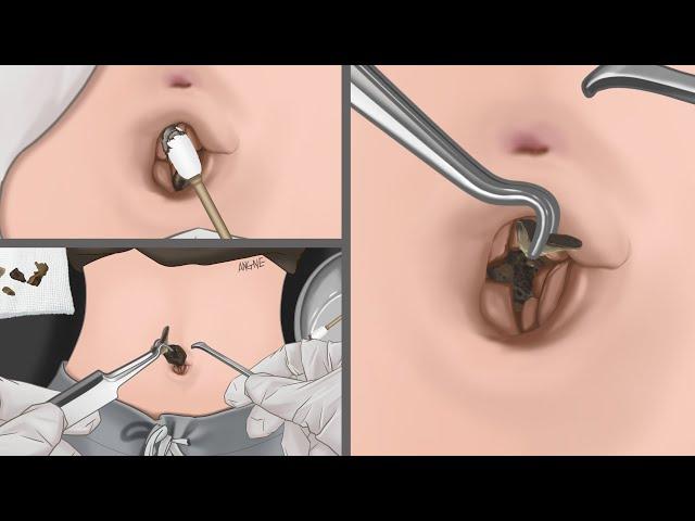 ASMR animation Removing Huge Navel Stone | Real sound | Tingle!