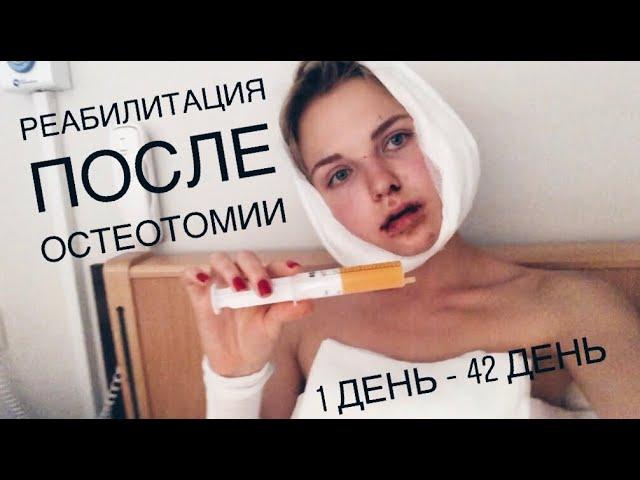 ПЕРВЫЕ ДНИ ПОСЛЕ ПЛАСТИЧЕСКОЙ ОПЕРАЦИИ | My Double Jaw Surgery Rehab