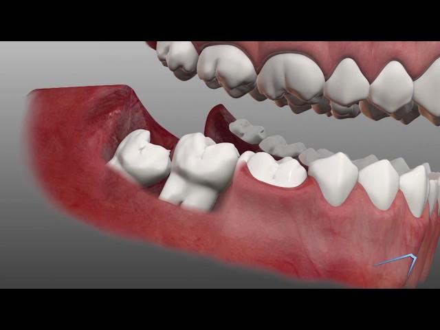 Wisdom Tooth Removal Information in Odessa TX | Permian Basin Oral Surgery & Dental Implant Center