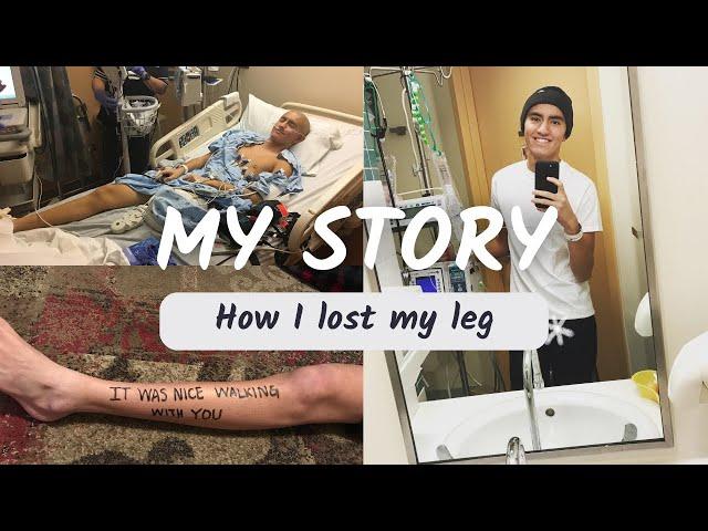 How I Lost My Leg - My Cancer Story