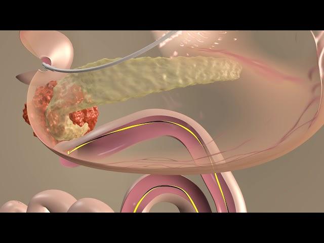 EUS guided gastroenterostomy - steps