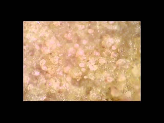 Scabies mites on skin crust