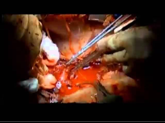 A Simple System for Video of Open Surgical Cases