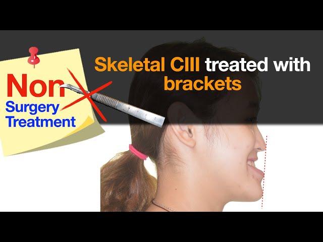 Skeletal Class III with nonsurgical treatment｜【Chris Chang Ortho】CC733