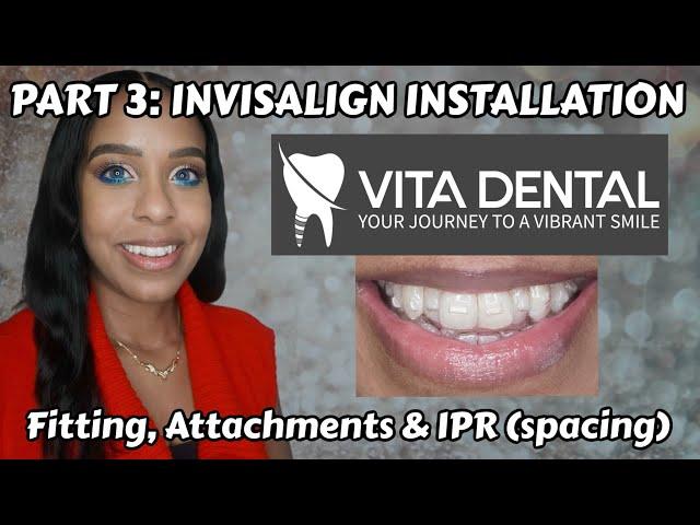 PART 3: I HAD MY INVISALIGN TRAYS PUT ON WITH DR A @ VITA DENTAL (Fitting, Attachments & IPR)