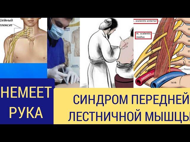 если не получается вылечить синдром передней лестничной мышцы ?