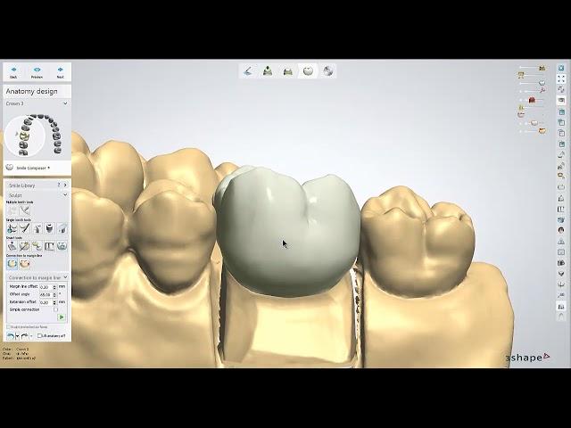 Dental Lab Life: Designing a Crown in 3Shape