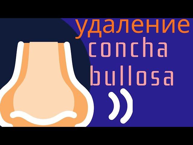 Резекция concha bullosa (Садыхов Р.А.)