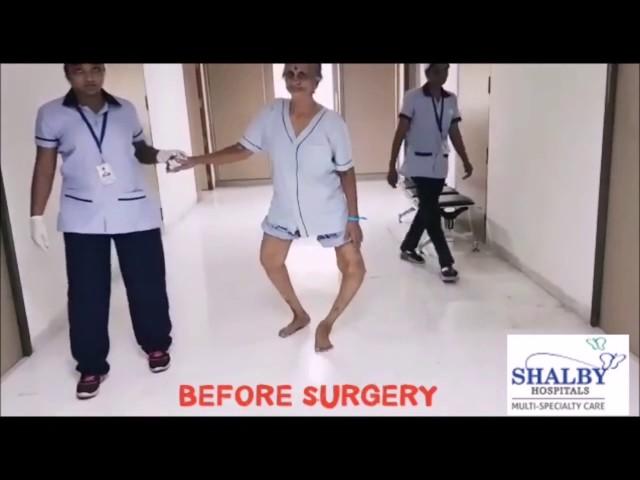 Witness the Power of Shalby’s "Zero Technique”  Total Knee Replacement Surgery