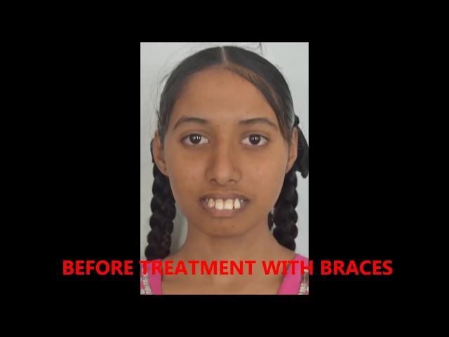 BEST BRACES TREATMENT IN KONDAPUR /SHERILINGAMPALLI BEST DENTIST/ORTHODONTIST VK DENTAL CLINIC