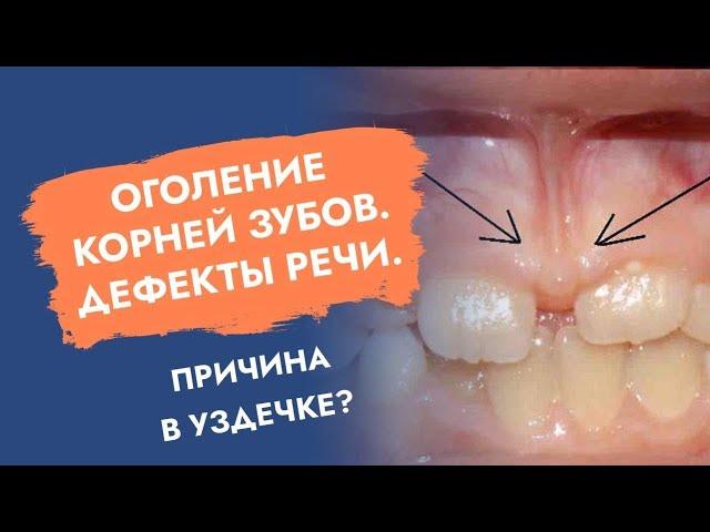 Оголение корней зубов. Дефекты речи. Причина - в уздечке?