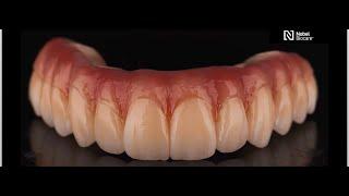 NobelProcera® Esthetic Zirconia Implant Bridge from start to finish | Courtesy of Sean Han