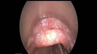 An acutely swollen epiglottis from AOD