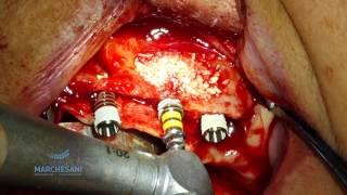 BILATERAL SINUS LIFT AND IMPLANTS PLACEMENT