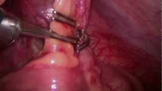 DS Ligation Clip System for Laparoscopic Appendectomy