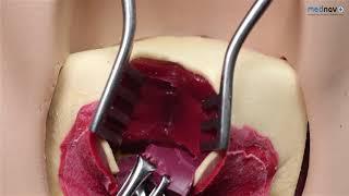 How to repair 3rd degree Perineal Tear