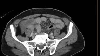 Acute Appendicitis