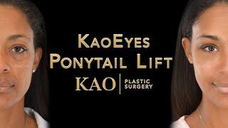 Ponytail Lift With KaoEyes | Everyone Said She Looked Tired Until She Had a Facelift