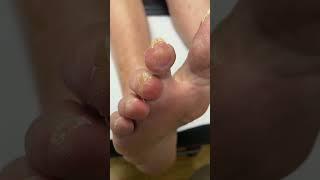 Watch as an Aussie podiatrist tackles callus & corn removal like a pro!