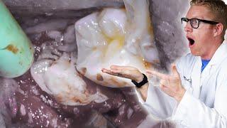 Dentist Shows Impacted Wisdom Tooth Removal Procedure! 3rd Molar Extraction Surgery Opening Gums!