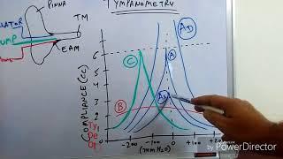 Tympanometry (Impedance Audiometry)