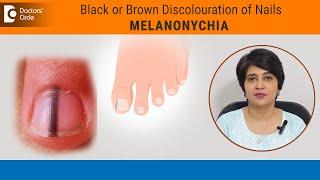 Black lines in nails| Streaks on Nail|Melanonychia Causes & Treatment-Dr.Rasya Dixit|Doctors' Circle