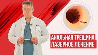 Анальная трещина - лазерное лечение