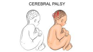 cerebral palsy/CP #cerebralpalsy #neuroconditions #physiotherapy #management